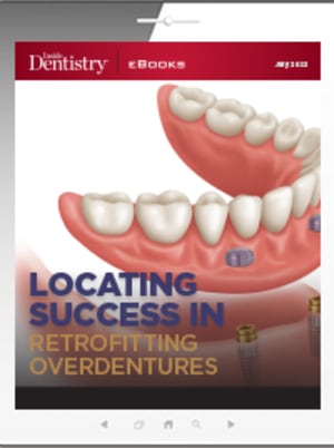 Locating Success in Retrofitting Overdentures