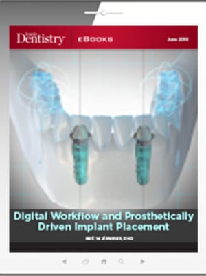 Digital Workflow and Prosthetically Driven Implant Placement