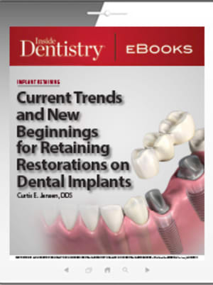Current Trends and New Beginnings for Retaining Restorations on Dental Implants