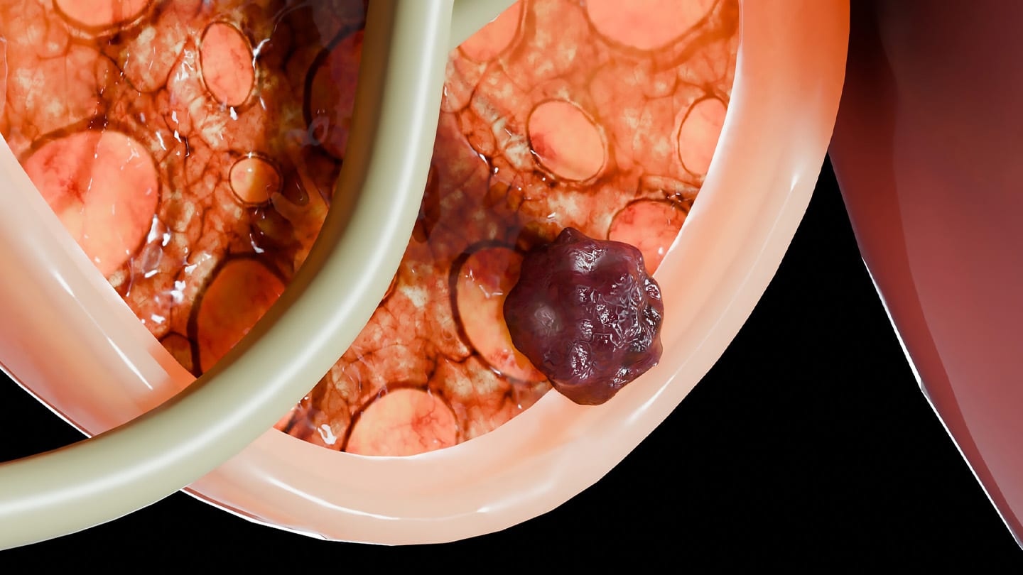 Medical image showing abnormal tissue in the prostate region.