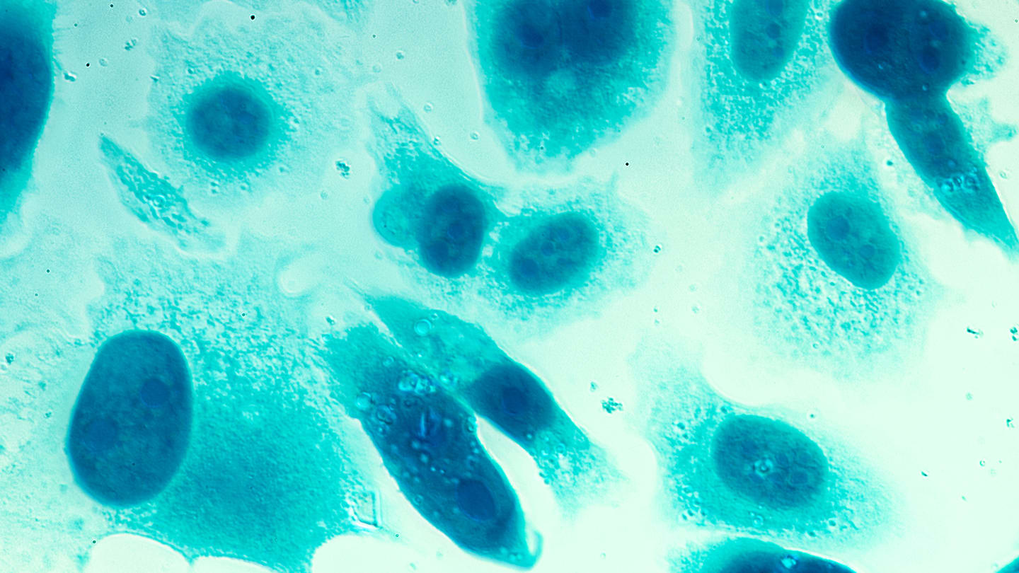 Prostate Cancer topic