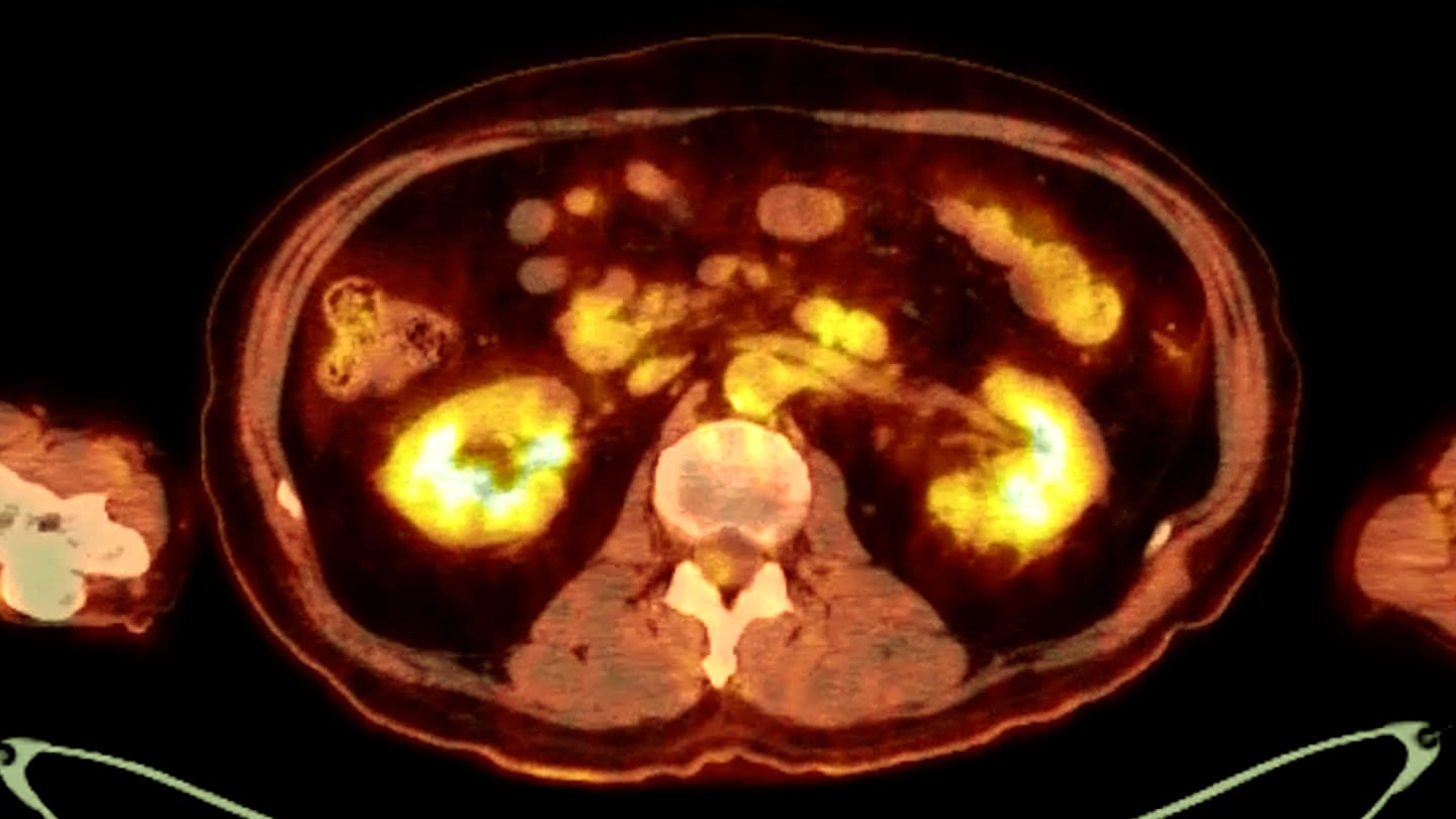 PET/CT image showing areas of tracer uptake.