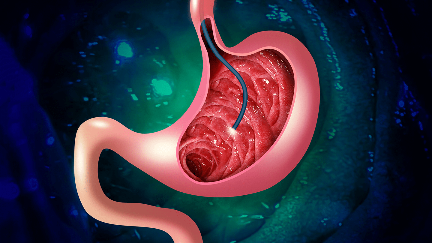 Illustration of an endoscope examining a stomach lesion.