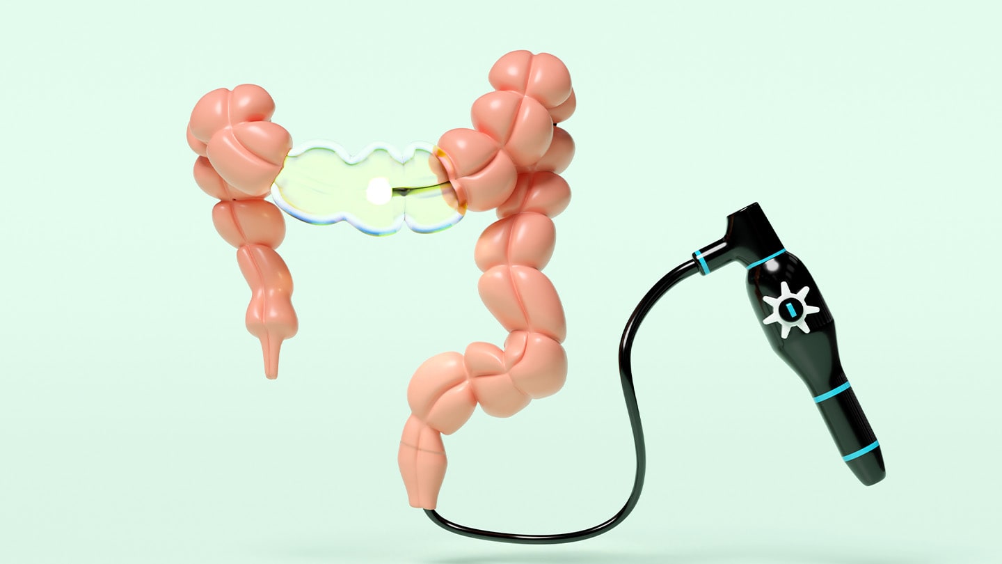 Illustration of the colon next to an endoscope.