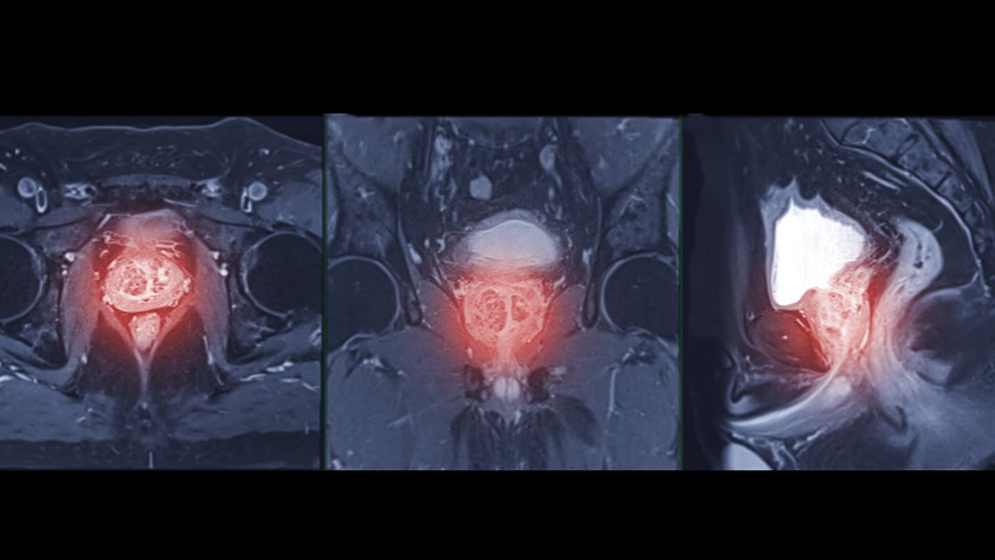 Medical scan showing a highlighted area in the pelvis.