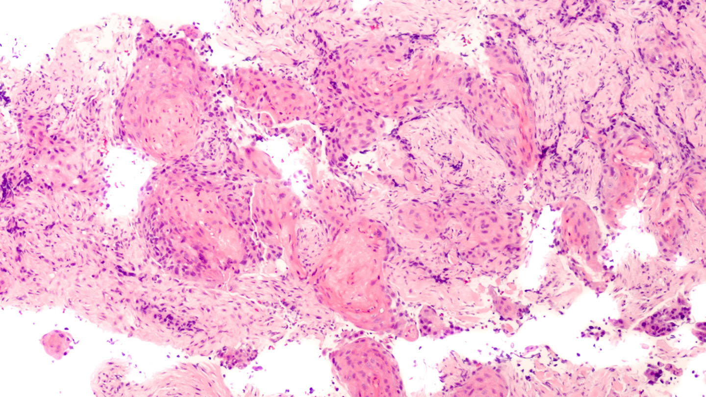 Non-Small Cell Lung Cancer  topic