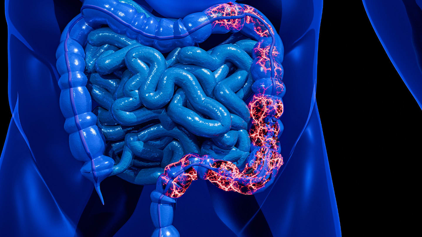 Illustration of intestines with inflamed areas highlighted.