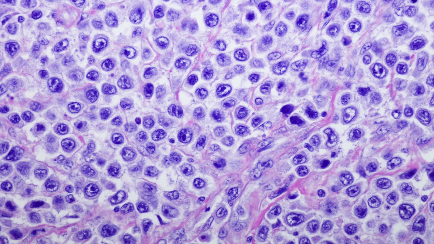 Microscopic image of densely packed lymphoma cells.