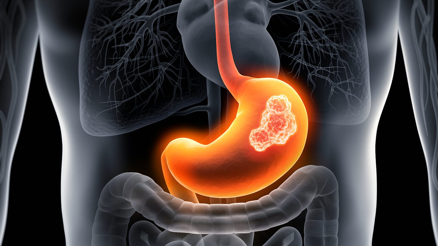 Illustration of the stomach with a highlighted tumor.