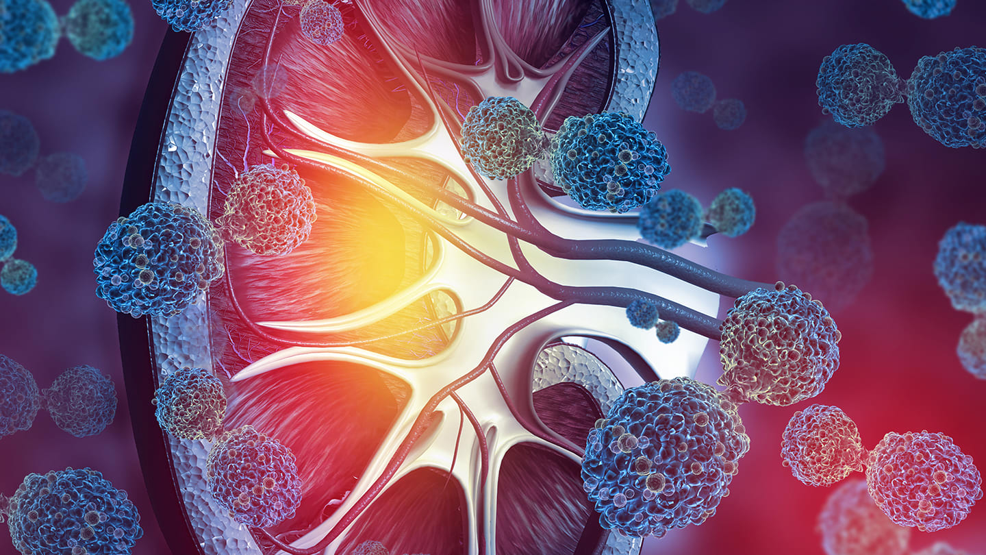 Illustration of a kidney surrounded by cancer cells.