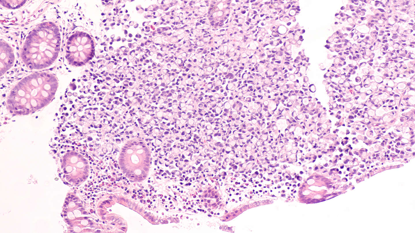 Gastric / Gastroesophageal Junction Cancer topic