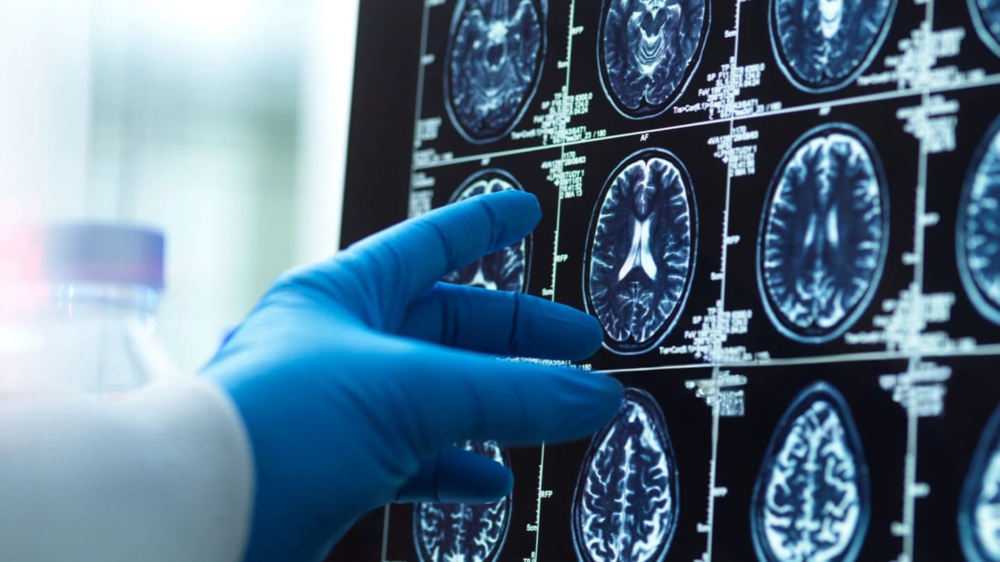 Gloved hand pointing to brain scans on a monitor.