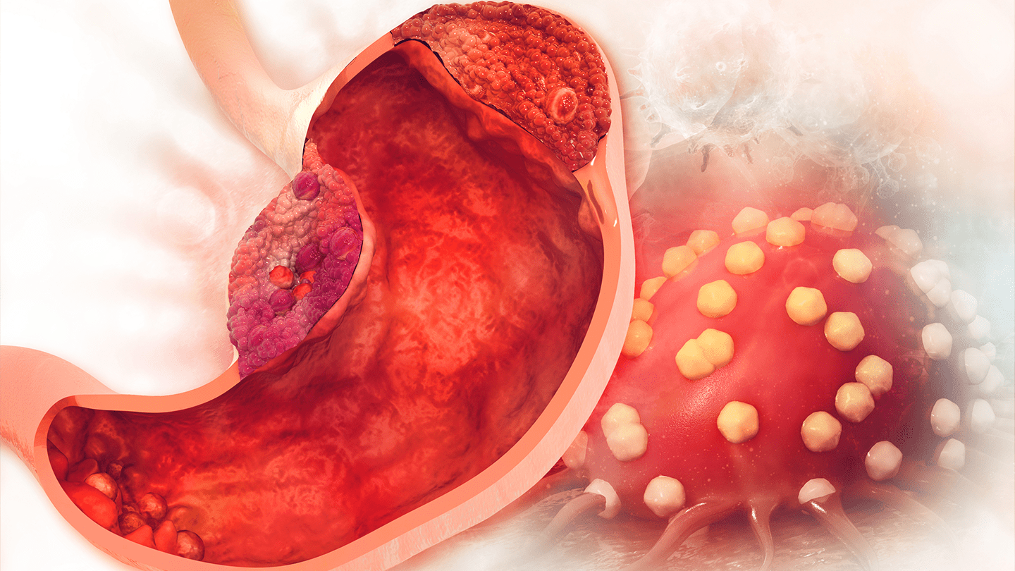 Illustration of a stomach with multiple lesions.