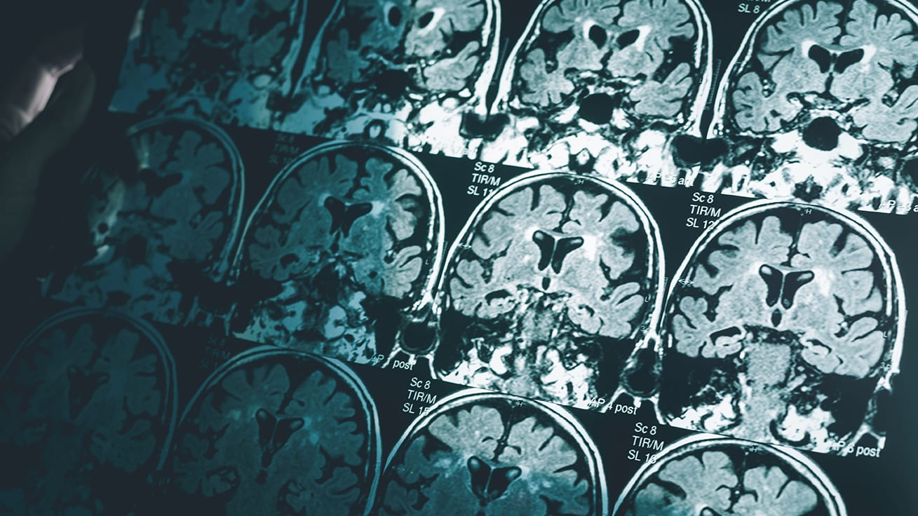 Alzheimer's Disease topic
