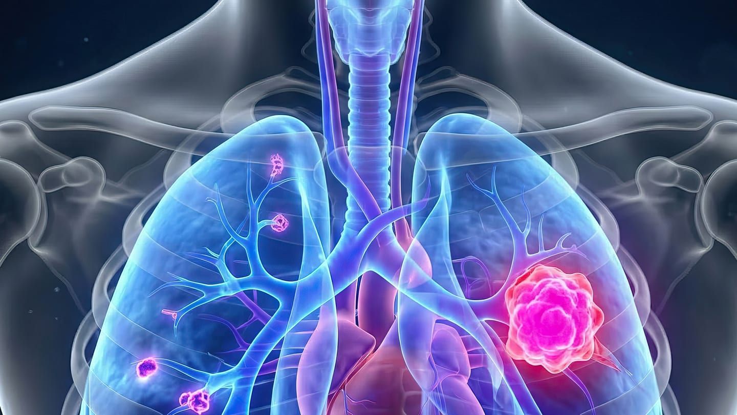 Illustration of lungs with a highlighted lung tumor.
