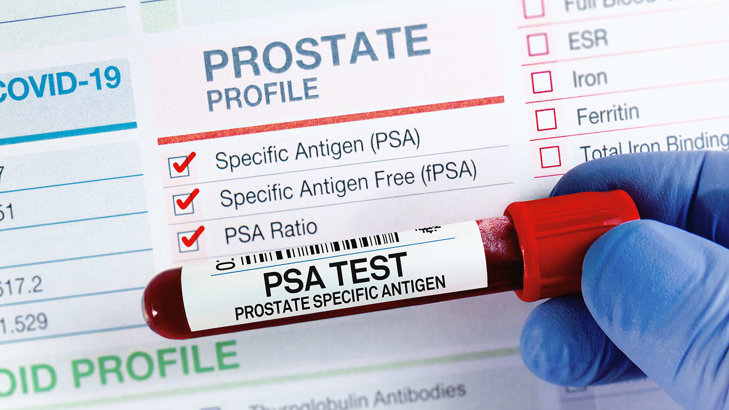 PSA blood test tube beside a prostate screening form.