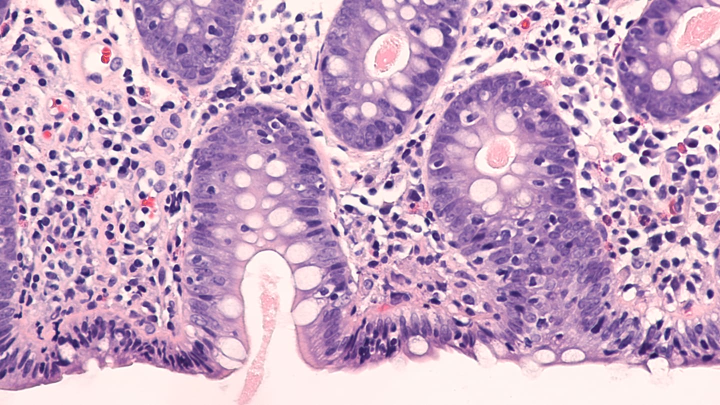 Inflammatory Bowel Disease  topic