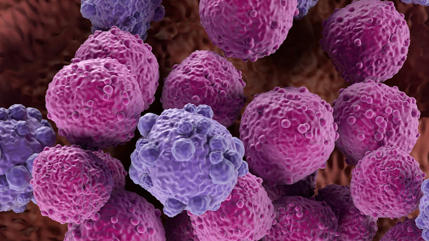 Microscopic illustration of clustered lymphoma cells.