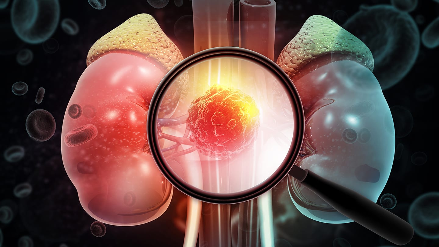 Illustration of kidneys with a highlighted lesion.