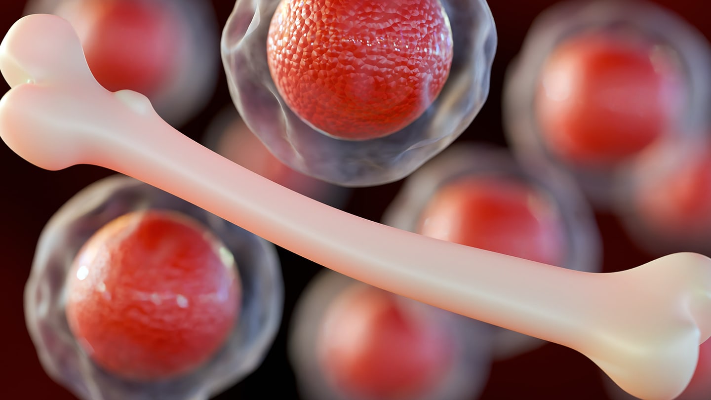 Illustration of bone marrow with abnormal plasma cells.