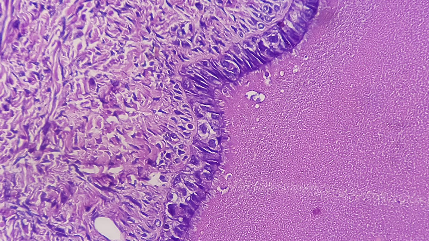 Gynecologic Cancers topic