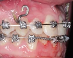 Skeletal, Dentoalveolar, Dental, and Soft-Tissue Effects Following MARPE Treatment: A Review