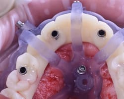 Complete Dual-Arch All-on-4® Rehabilitation Using a Fully Digital Workflow: A Case Report