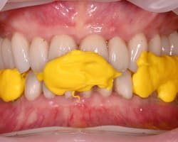 Restorative Management of Constriction and Spacing Following Arch Expansion