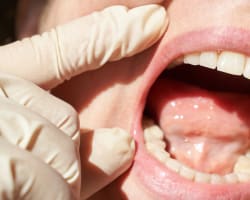 Soft-Tissue Oral Cysts: Recognition, Red Flags, and Referral Criteria for RDHs       