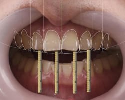 A Transitional Full-Mouth Rehabilitation Using Injection-Molded Composite: A 6-Year Clinical Follow-up