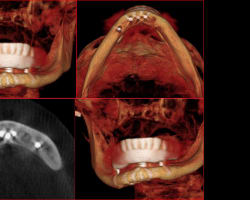 Removal of a 40-Year-Old Infected Mandibular Staple Implant and a Fixed Reconstruction: A Case Report