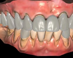Esthetic and Functional Rehabilitation of Severely Worn Dentition Using Facially Driven Treatment Planning and Digital Workflow