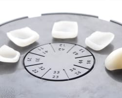 Meeting an Esthetic Challenge: Shade Matching Veneers and a Crown on Maxillary Incisors