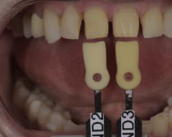 Managing Esthetics and Economics in the Older Patient: A Case Report