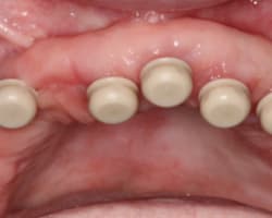 Achieving a Predictable, Fixed Full-Arch Implant-Supported Restoration