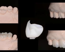 A 7-Year Follow-up: Managing Biomechanics, Function, and an Esthetic Disability