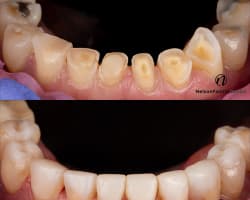 OMNICHROMA: A Predictable, Esthetic Solution for Anterior Composite Cases