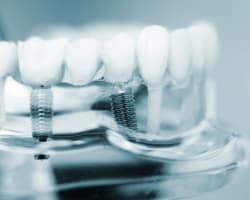A Framework for Better Implant Case Selection