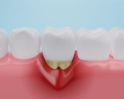 RA Genetics May Reveal Link to Gum Disease + Thumbnail