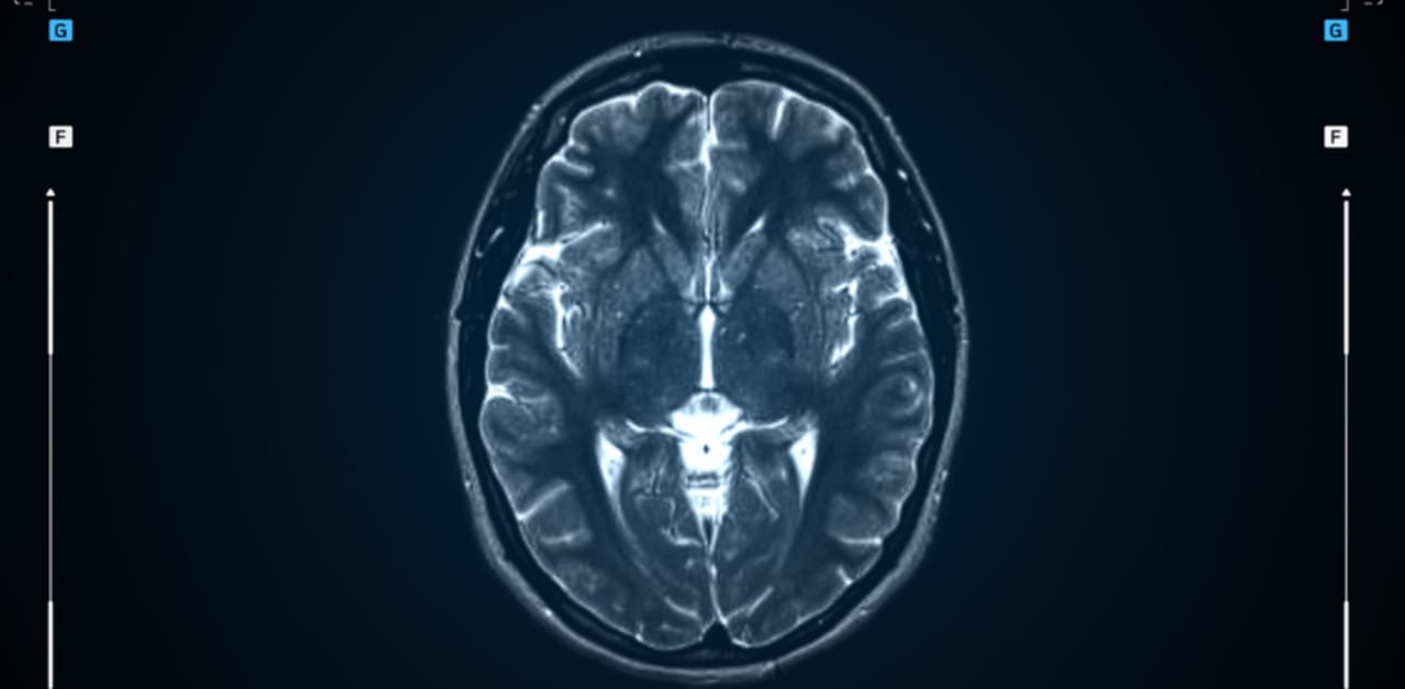 MRI Identifies 3 Friedreich Ataxia Subtypes