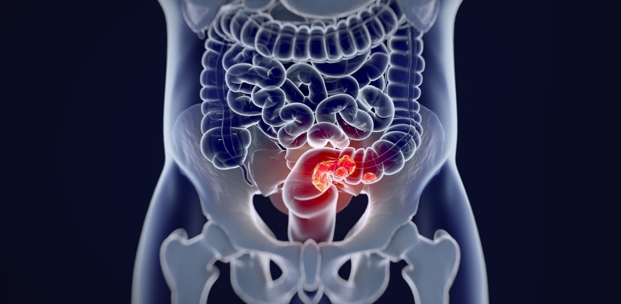 Immunoscore Refines CRC Prognosis, Therapy