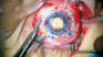 2026 Surgical Roundtable Case 3: Fixing a Tilted Secondary IOL