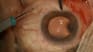 Surgical Posterior Capsulectomy