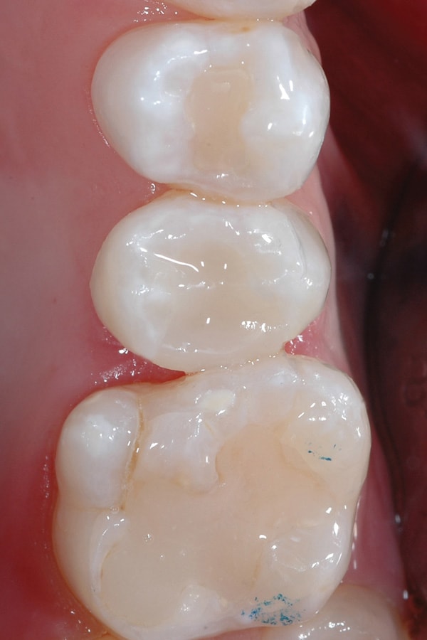 Fig 11.