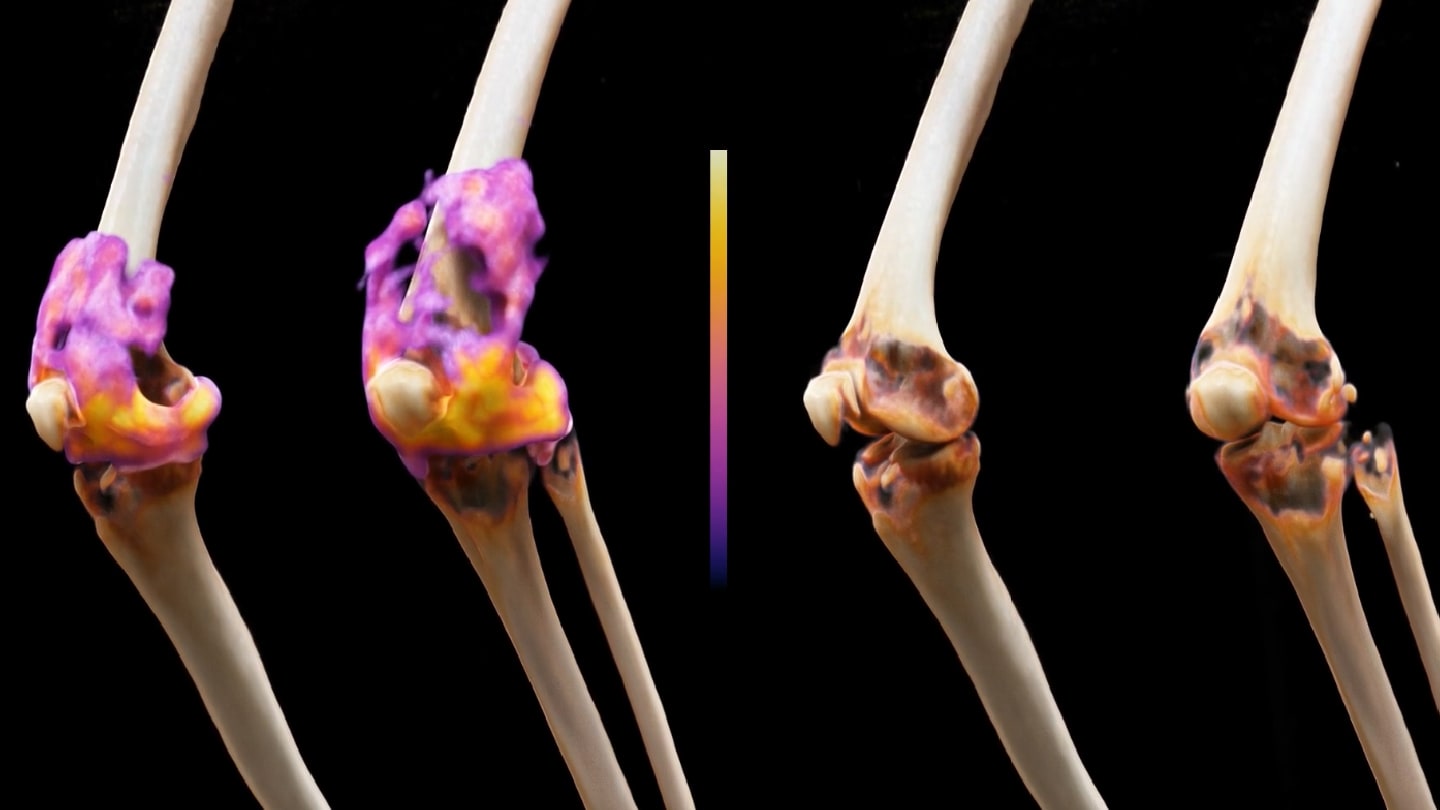 CD19 CAR T Therapy Tested in Refractory Rheumatoid Arthritis