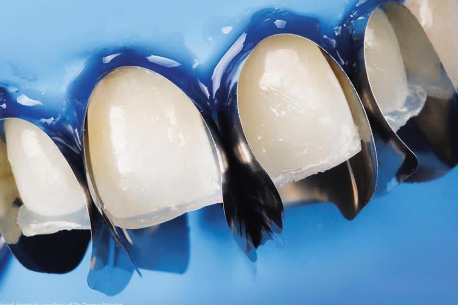 Unica Anterior Matrix System