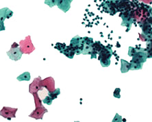 Acupath First Commercial Lab to Offer URO17™, Innovative New Bladder Cancer Biomarker