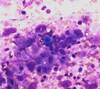Giemsa’s rapid stain for clinical & intraoperative cytology