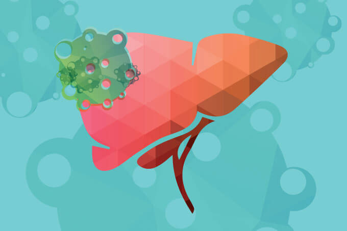 A Longer Life With Liver Cancer