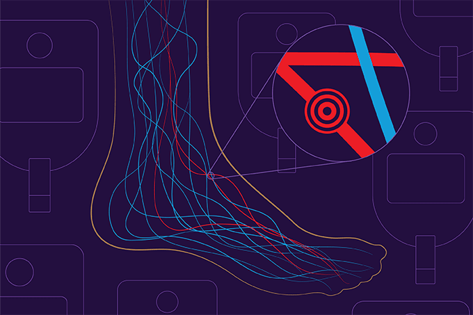 Demystifying Diabetic Neuropathy